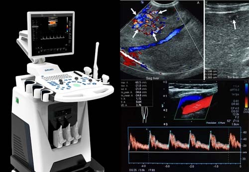 Colour Doppler